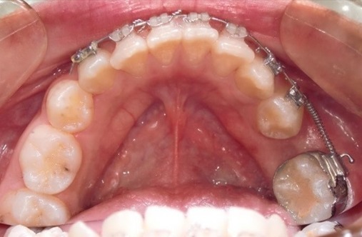 永久歯萌出異常に対する一連の矯正治療 AFTER