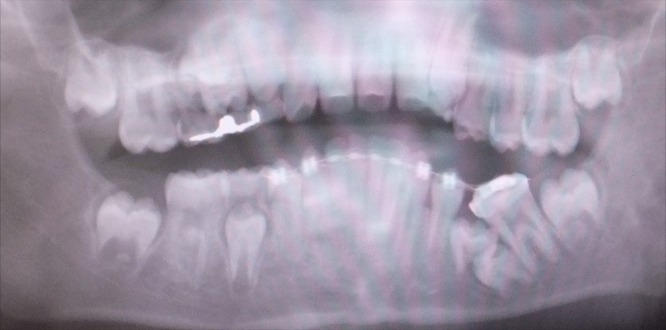 永久歯萌出異常に対する一連の矯正治療 BEFORE