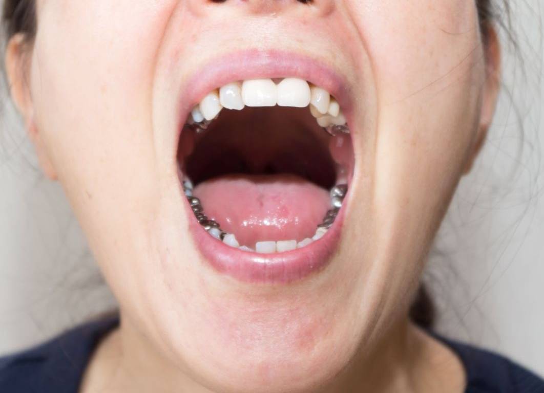 対合歯の挺出