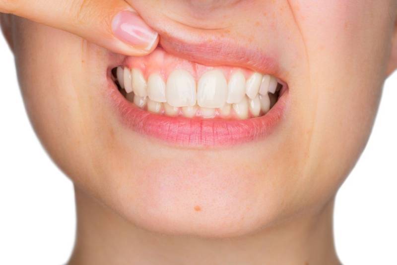 銀歯は白くしたほうがいい？メタルフリー治療の時代の流れと潮流 歯茎の黒ずみ
