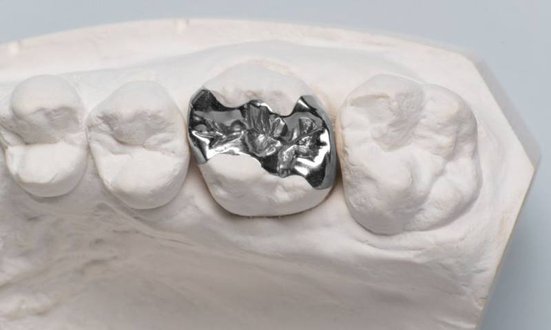 銀歯は白くしたほうがいい？メタルフリー治療の時代の流れと潮流 アマルガム